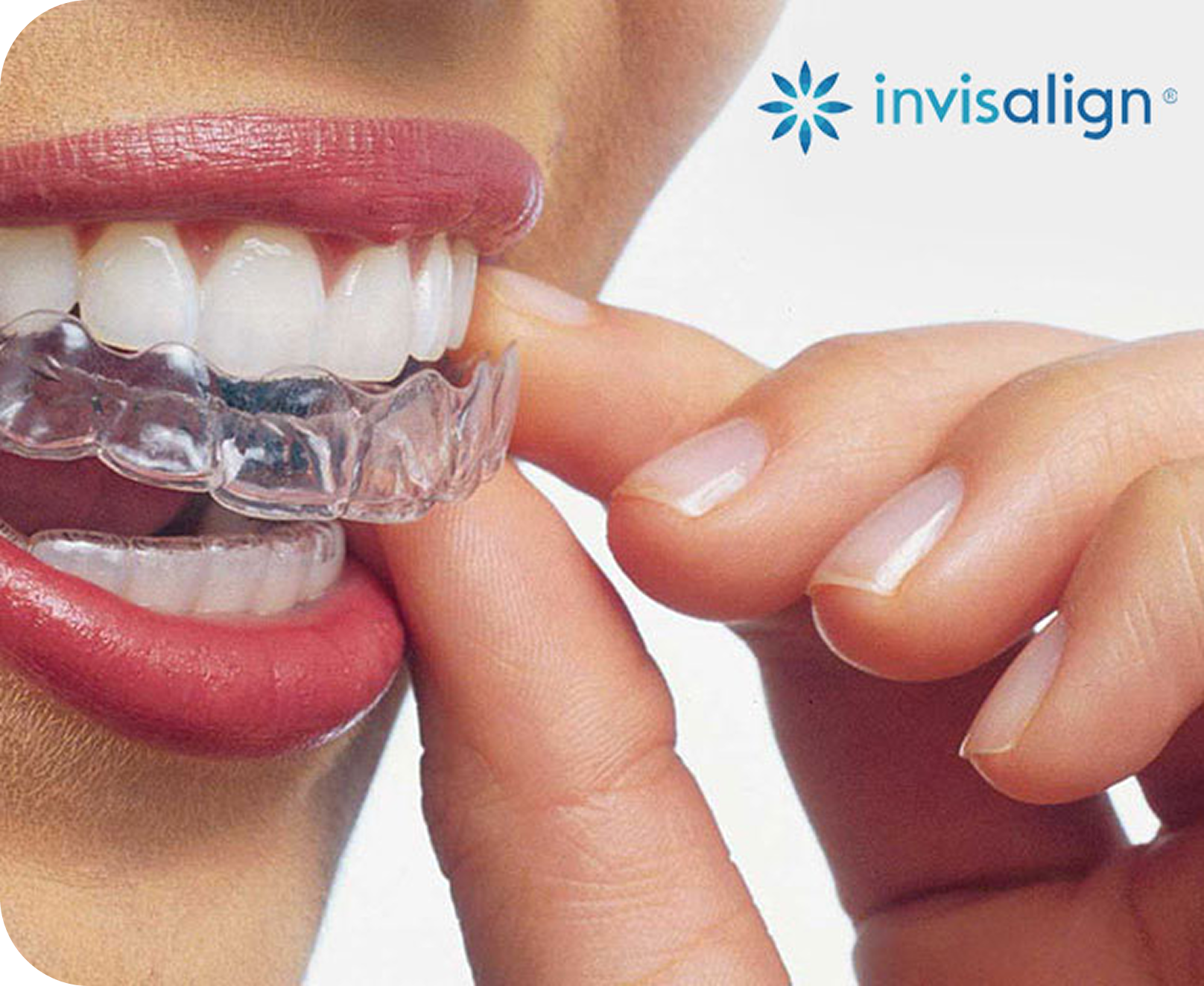 Invisalign